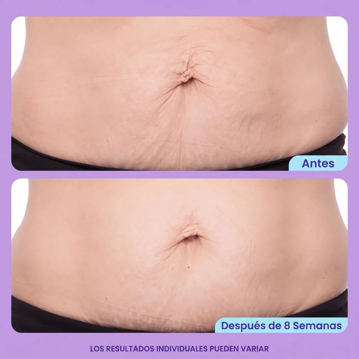 Corpela® Reafirmante Densificante Piel Abdominal